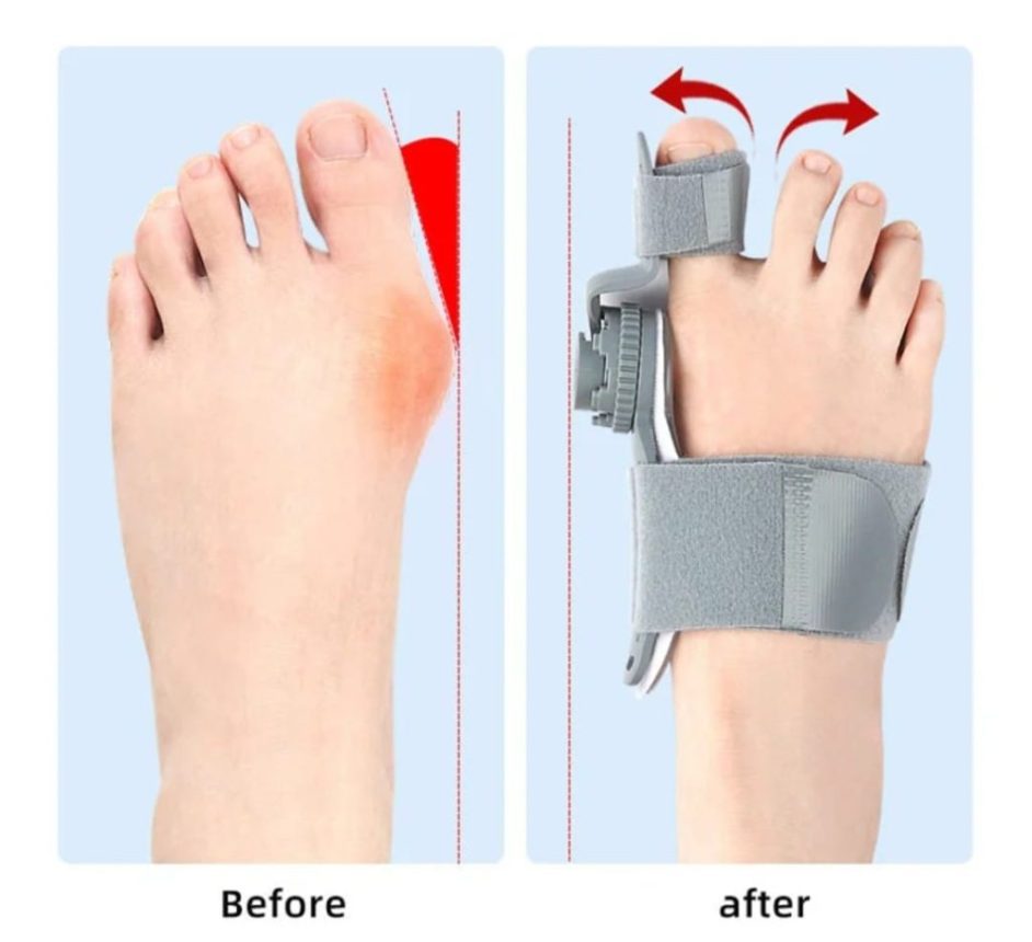 CORRECTOR DE JUANETES DE ULTIMA GENERACIÓN - Imagen 5